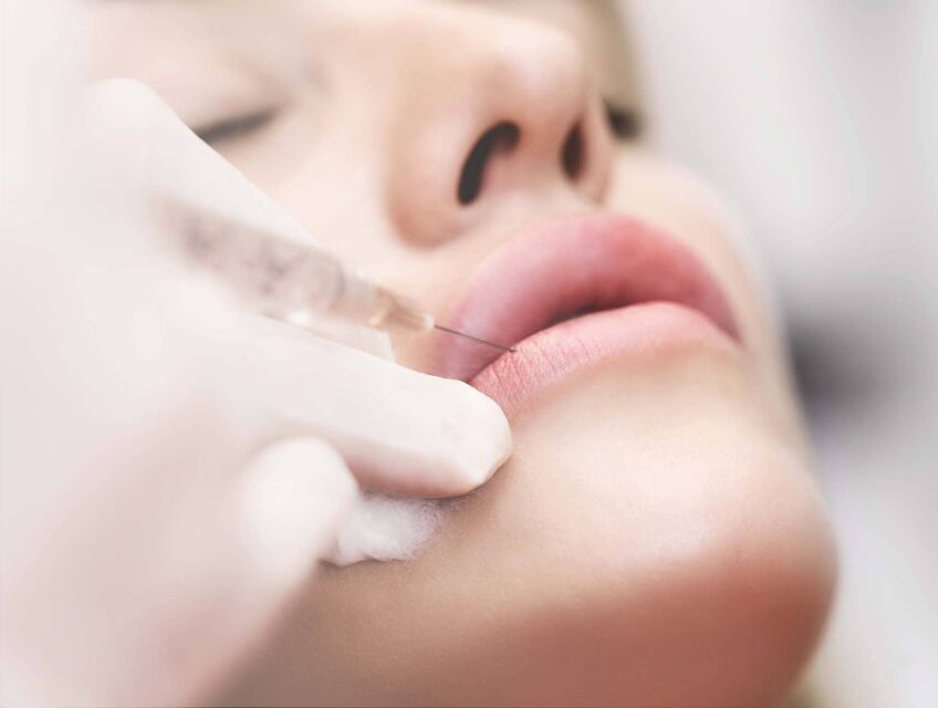 Injections d'acide hyaluronique dans les lèvres : technique et prix à Compiègne | Beauxmonts