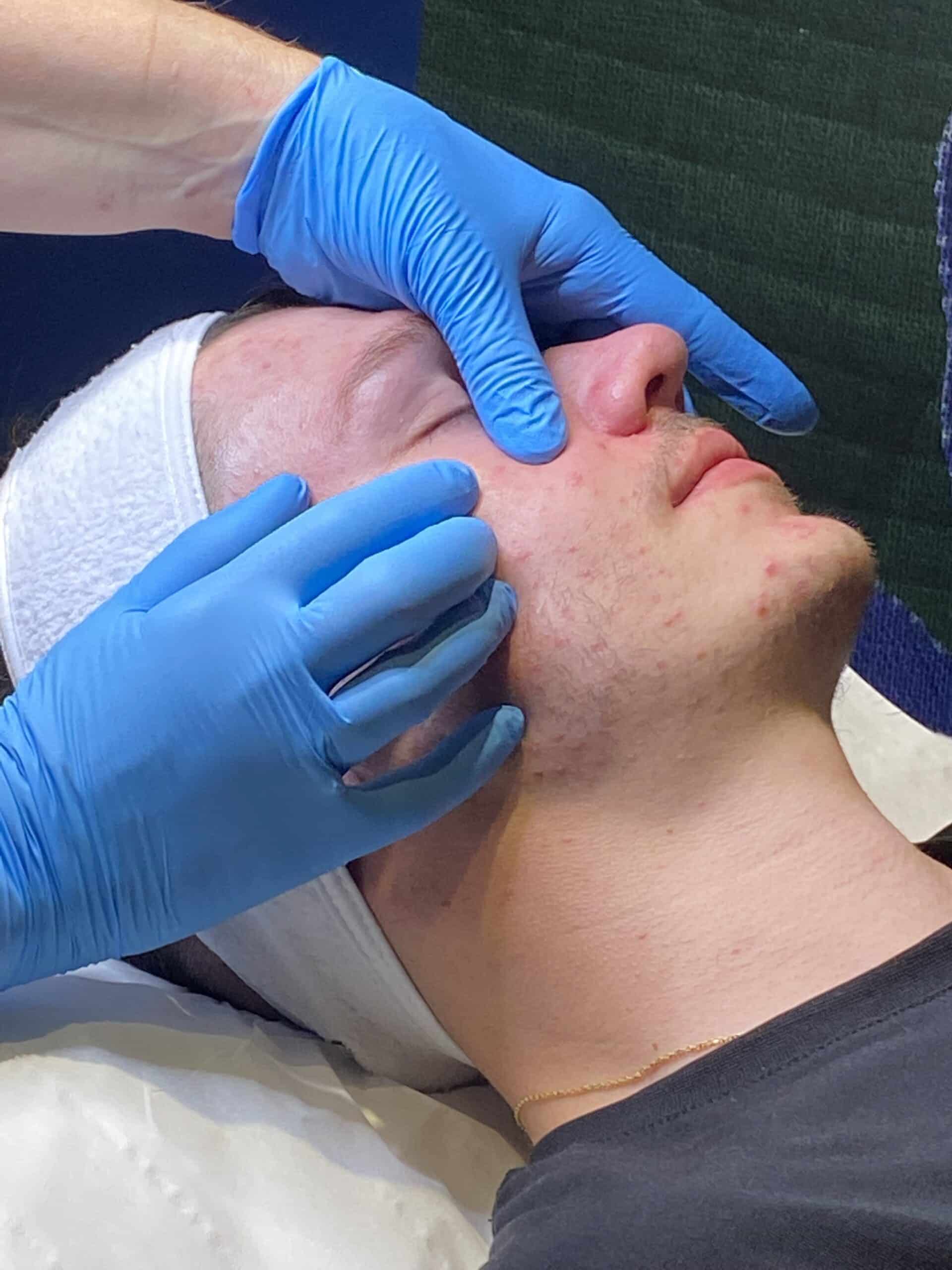 Nettoyage de peau médical sur jeune patient atteint d'acné.